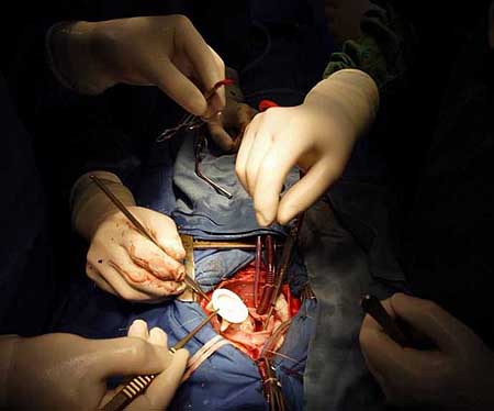 记录的外科专家为一个10多岁小女孩做的一台心脏瓣膜植入手术全过程