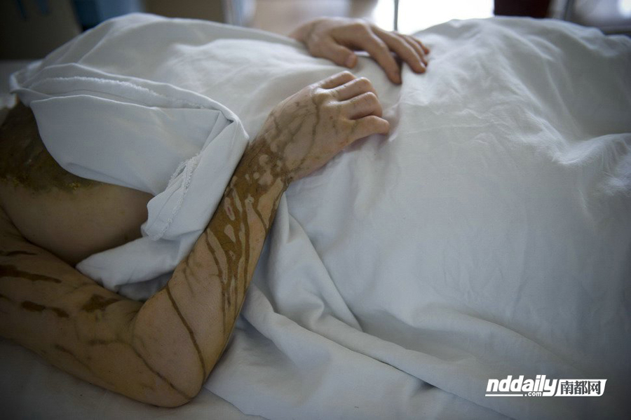 女子被泼硫酸疑误当第三者 受伤前生活照曝光/组图